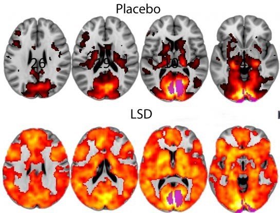 LSD placebo brain scan images